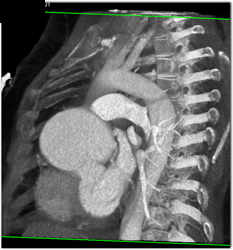 Dilated Aortic Root - CTisus CT Scan