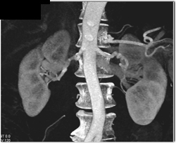 Fibromuscular Dysplasia (FMD) of Renal Arteries - CTisus CT Scan