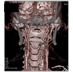 Tortuous Carotid Artery and Loeytz Dietz - CTisus CT Scan