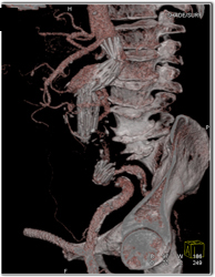 Bend in Stent - CTisus CT Scan