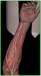 CTA Renderings of Arm in Various Parameters - CTisus CT Scan