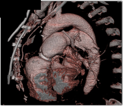 Post Repair Ascending Aorta - CTisus CT Scan