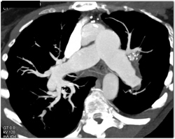 Dilated Pulmonary Arteries With Chronic Pe - CTisus CT Scan