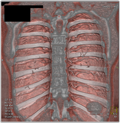 Definition of Intercostal Artery With Various Lighting Modes - CTisus CT Scan