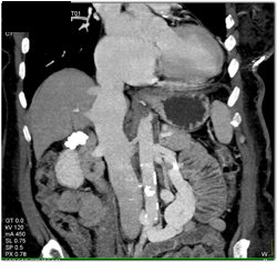 Reflux Into IVC Due to Failure - CTisus CT Scan