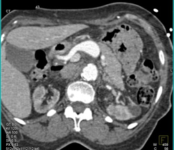 Celiac Artery Aneurysm - CTisus CT Scan