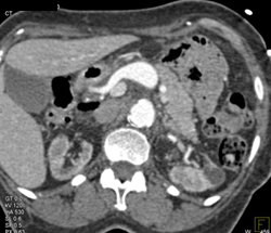 Celiac Artery Aneurysm - CTisus CT Scan