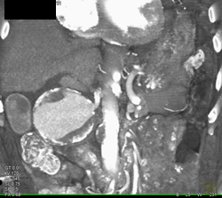 Hepatic Artery Aneurysm - CTisus CT Scan