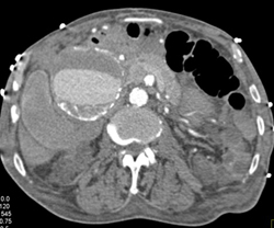 Hepatic Artery Aneurysm - CTisus CT Scan