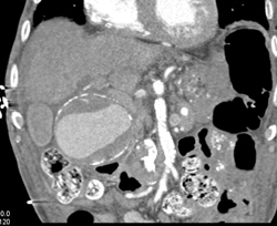 Hepatic Artery Aneurysm - CTisus CT Scan