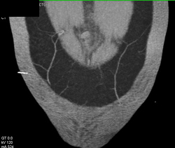 DIEP Planning - CTisus CT Scan