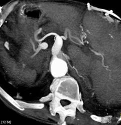 Celiac Stenosis and Focal Dilation - CTisus CT Scan