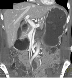 Superior Mesenteric Artery (SMA) Syndrome Sequence - CTisus CT Scan