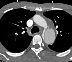 Type B Dissection - CTisus CT Scan