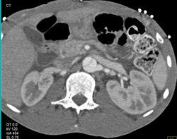 Type B Dissection - CTisus CT Scan