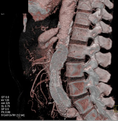 Stenosis Celiac and SMA Origins With Post Stenotic Dilation - CTisus CT Scan