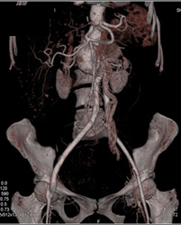 Aorto Bifemoral Graft and Aneurysm Repair - CTisus CT Scan