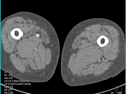 SFA- Tibial Bypass Graft and Peripheral Vascular Disease (PVD) - CTisus CT Scan