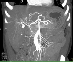 Cirrhosis With Partial Portal Vein Thrombosis (PVT) - CTisus CT Scan