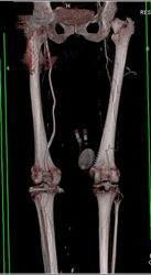 Peripheral Vascular Disease (PVD) With Artifact Off Total Knee Replacement (TKR) - CTisus CT Scan