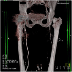 Total Hip Replacement (THR) With CTA and Artifact - CTisus CT Scan