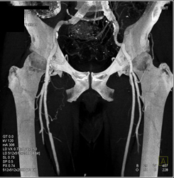 Stenosis Superficial Femoral Artery (SFA) - CTisus CT Scan