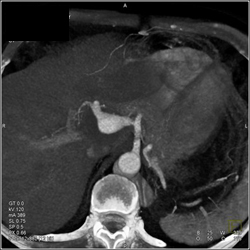 Hepatic Artery Aneurysm - CTisus CT Scan