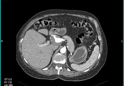 Hepatic Artery Aneurysm - CTisus CT Scan