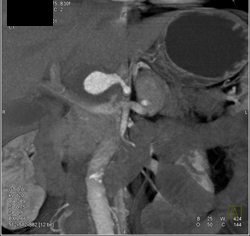 Hepatic Artery Aneurysm - CTisus CT Scan