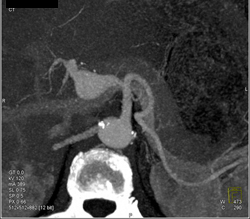 Hepatic Artery Aneurysm - CTisus CT Scan