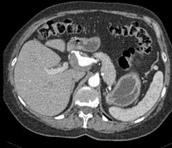 Hepatic Artery Aneurysm - CTisus CT Scan