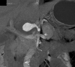 Hepatic Artery Aneurysm - CTisus CT Scan