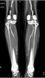 Run Off With Editing and Peripheral Vascular Disease (PVD) - CTisus CT Scan