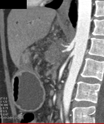 Celiac Artery Encased By Pancreatic Cancer - CTisus CT Scan