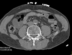 Occlusion of Right Common Iliac Artery - CTisus CT Scan