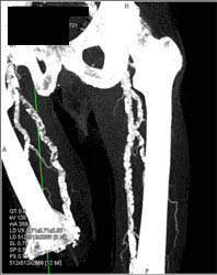 Severe Vascular Disease With Right AKA (above-the-knee amputation) - CTisus CT Scan