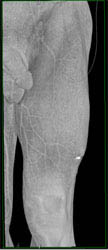 GSW Thigh With Active Extravasation Seen With Multiple Renderings - CTisus CT Scan