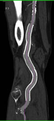 3D Map of Vessel Center Line - CTisus CT Scan