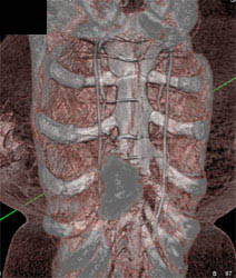 Internal Mammary Arteries With Enhanced Lighting Model - CTisus CT Scan