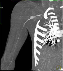 Bleed From Stabbing With Axillary Artery Injury - CTisus CT Scan