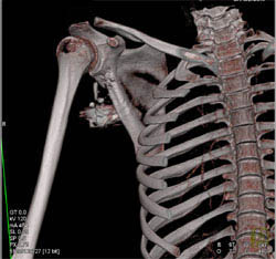 Bleed From Axillary Artery With GSW and Scapular Fracture - CTisus CT Scan