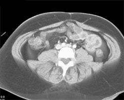 DIEP Planning for Epigastric Arteries - CTisus CT Scan