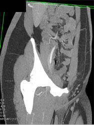 DIEP Flap Planning - CTisus CT Scan