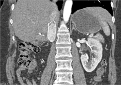 Filter in Inferior Vena Cava (IVC) - CTisus CT Scan