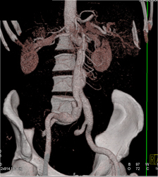 Aortic Dissection - CTisus CT Scan