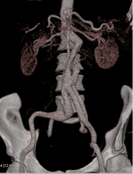 Aortic Dissection - CTisus CT Scan