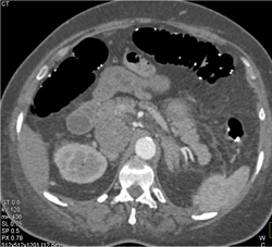 Renal Cancer With Tumor Extension to IVC and Right Atrium - CTisus CT Scan