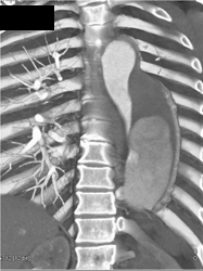 Type B Dissection - CTisus CT Scan