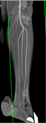 Occlusion of Anterior Tibial Artery Was A Computer Generated Artifact - CTisus CT Scan