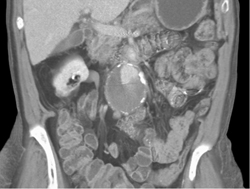 Endoleak - CTisus CT Scan